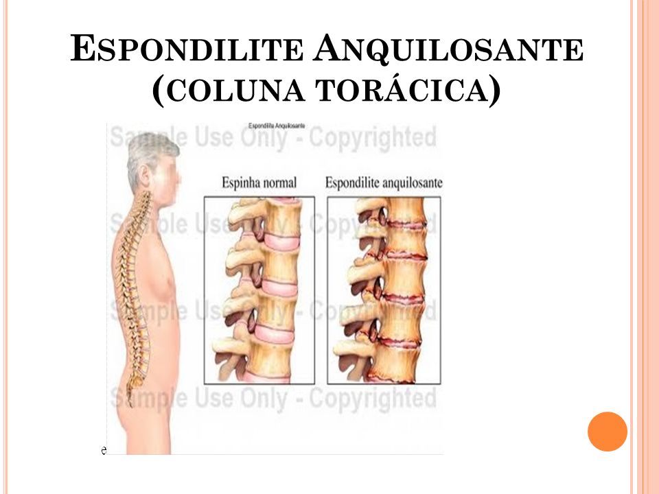 Espondilite Anquilosante (coluna torácica)