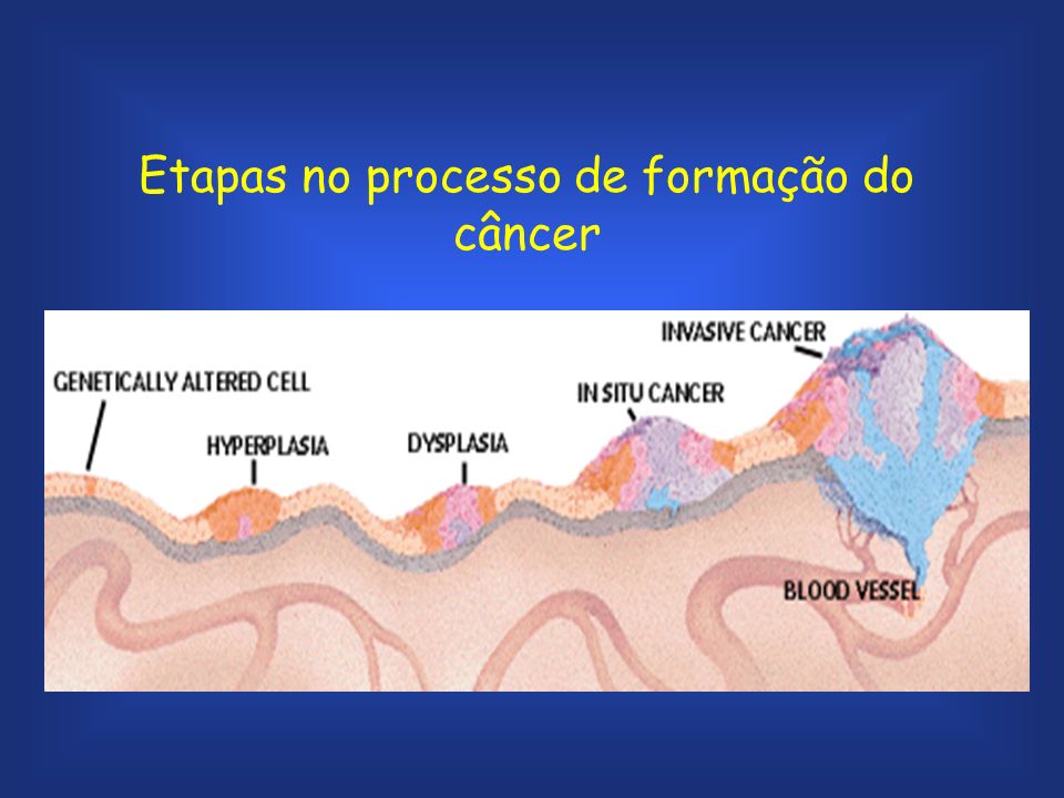 Etapas no processo de formação do câncer