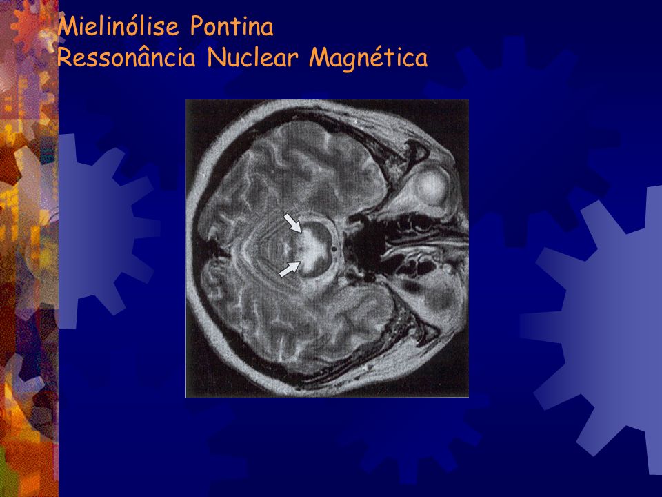Mielinólise Pontina Ressonância Nuclear Magnética