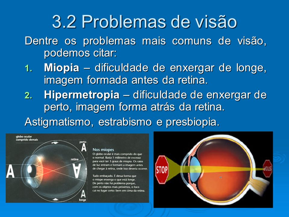 3.2 Problemas de visão Dentre os problemas mais comuns de visão, podemos citar: