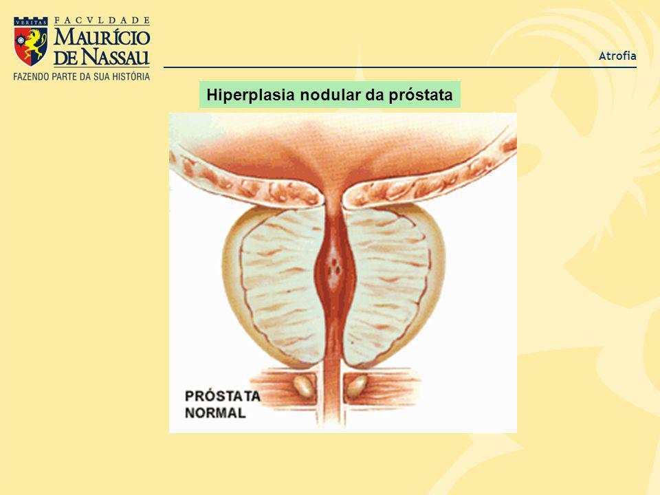 Hiperplasia nodular da próstata