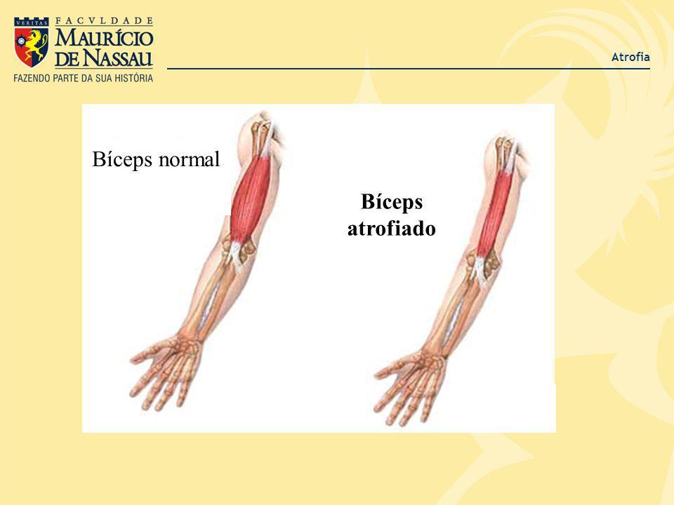 Atrofia Bíceps normal Bíceps atrofiado