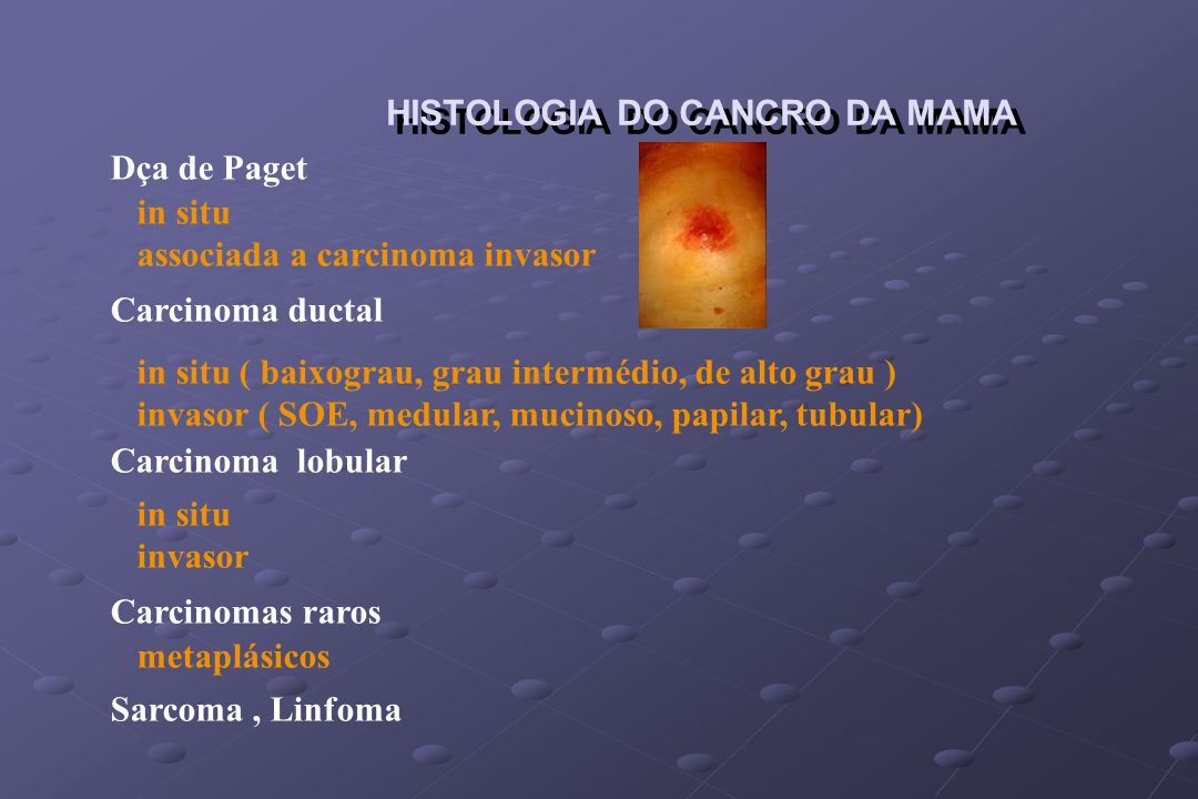 HISTOLOGIA DO CANCRO DA MAMA