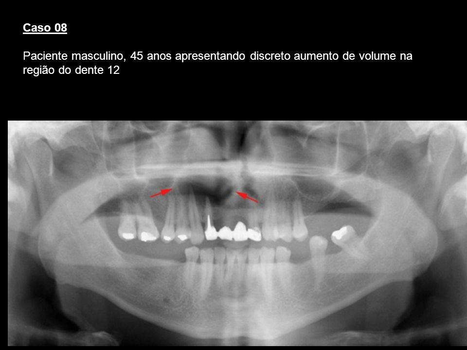 Caso 08 Paciente masculino, 45 anos apresentando discreto aumento de volume na região do dente 12. Cisto periapical.