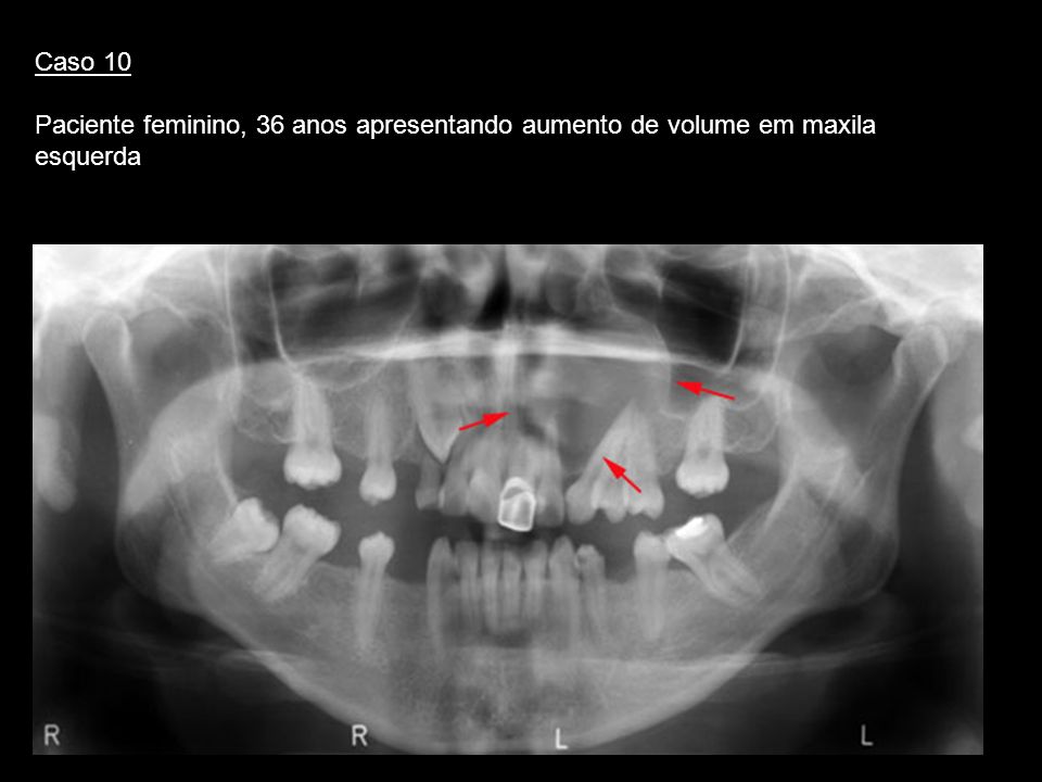Caso 10 Paciente feminino, 36 anos apresentando aumento de volume em maxila esquerda. Cisto residual.