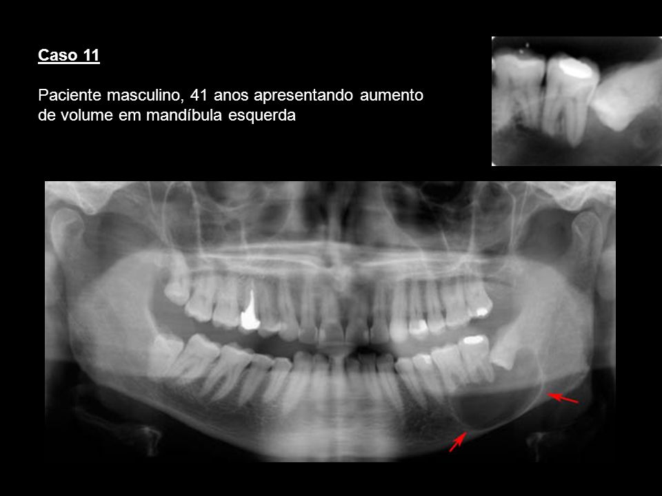 Caso 11 Paciente masculino, 41 anos apresentando aumento de volume em mandíbula esquerda. Cisto dentigero.