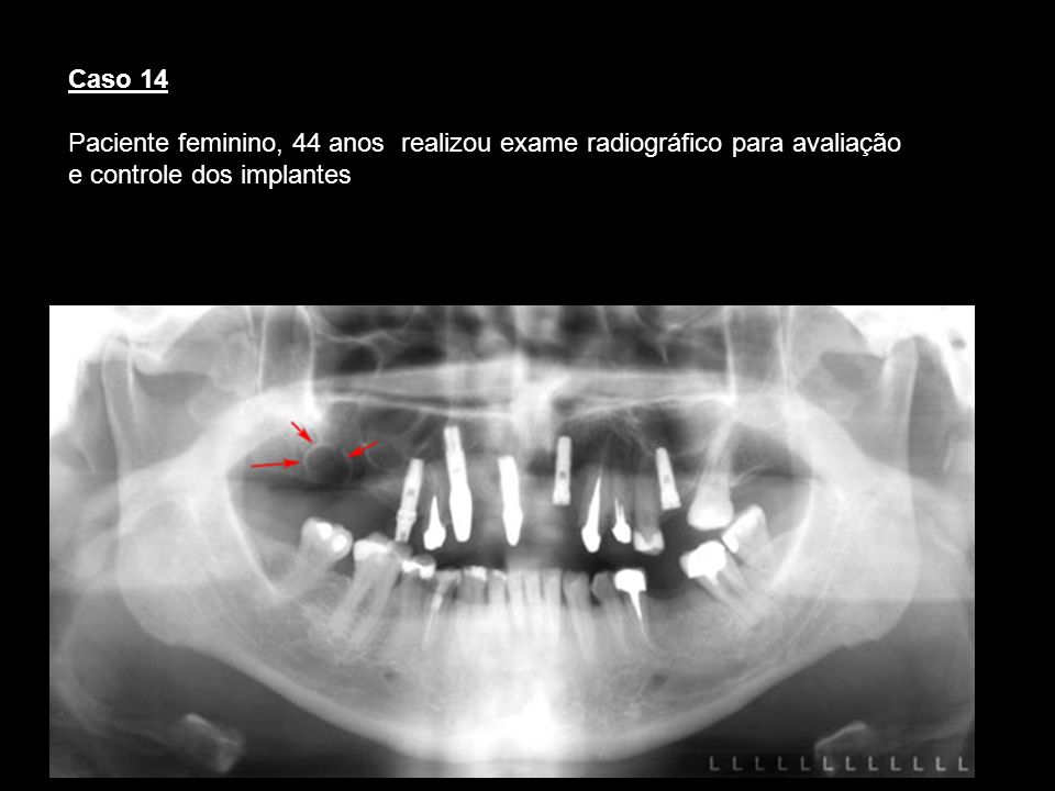 Caso 14 Paciente feminino, 44 anos realizou exame radiográfico para avaliação e controle dos implantes.