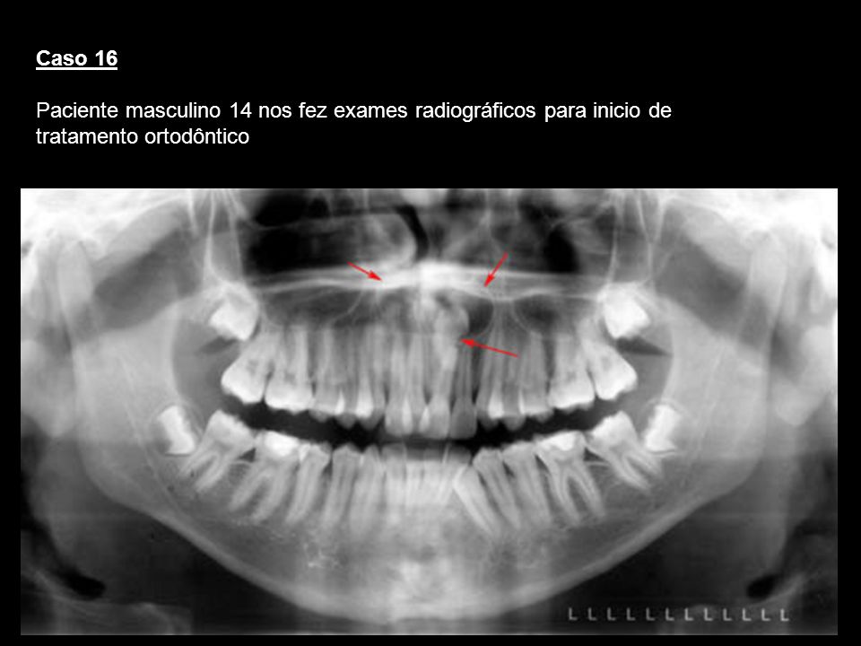 Caso 16 Paciente masculino 14 nos fez exames radiográficos para inicio de tratamento ortodôntico. Cisto dentigero.