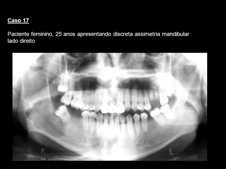 Caso 17 Paciente feminino, 25 anos apresentando discreta assimetria mandibular lado direito. Querato.