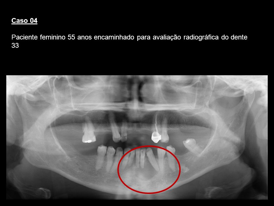 Caso 04 Paciente feminino 55 anos encaminhado para avaliação radiográfica do dente 33. Cisto Periapical.