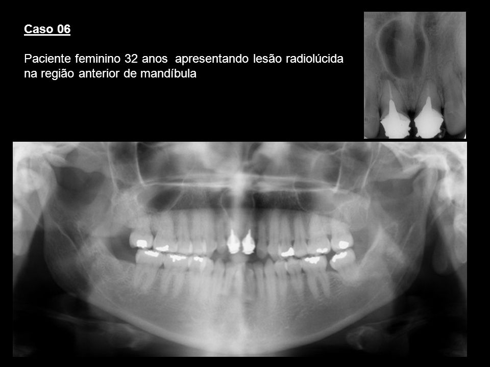Caso 06 Paciente feminino 32 anos apresentando lesão radiolúcida na região anterior de mandíbula. Cisto ducto nasopalatino.
