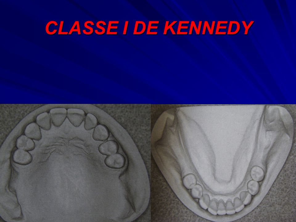 CLASSE I DE KENNEDY