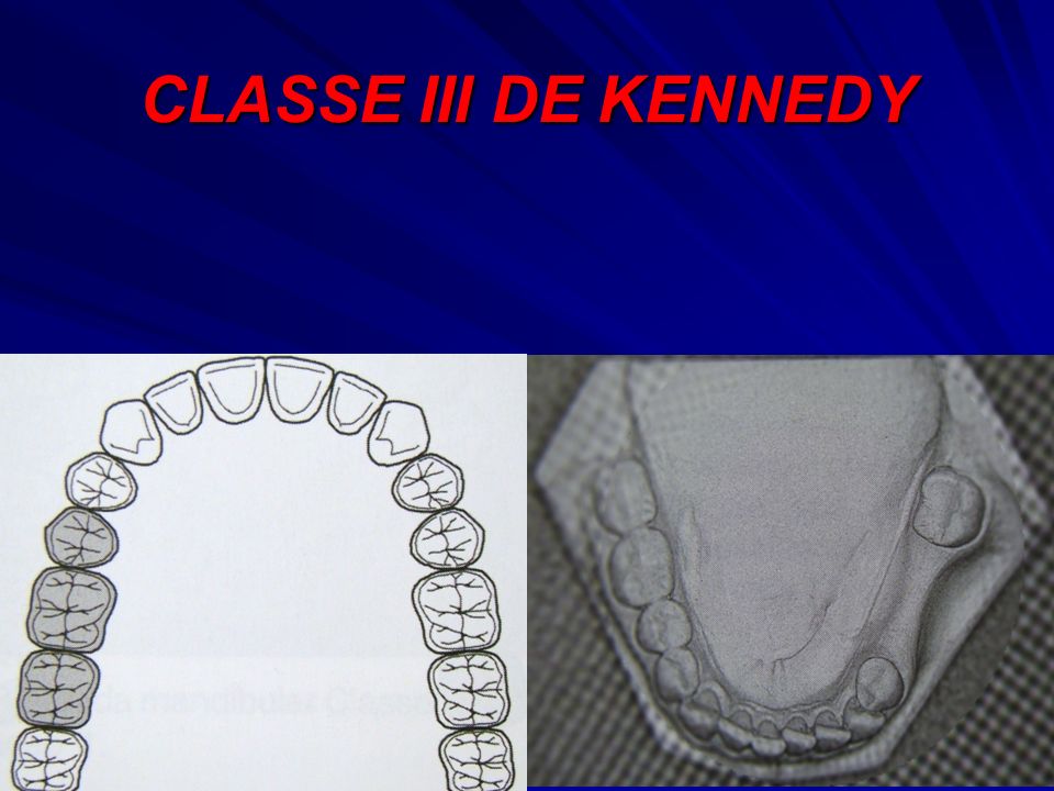 CLASSE III DE KENNEDY