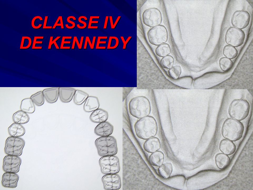 CLASSE IV DE KENNEDY