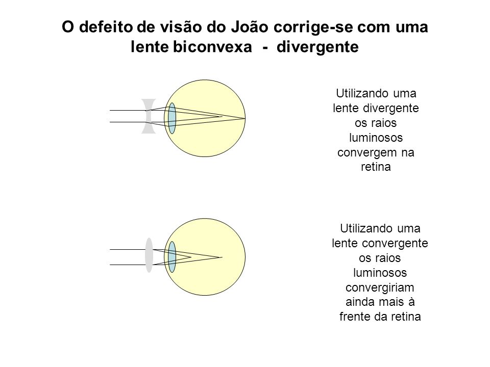 Utilizando uma lente divergente os raios luminosos convergem na retina