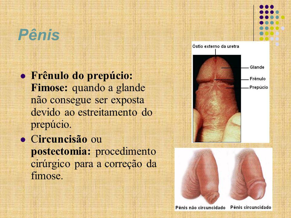 Pênis Frênulo do prepúcio: Fimose: quando a glande não consegue ser exposta devido ao estreitamento do prepúcio.