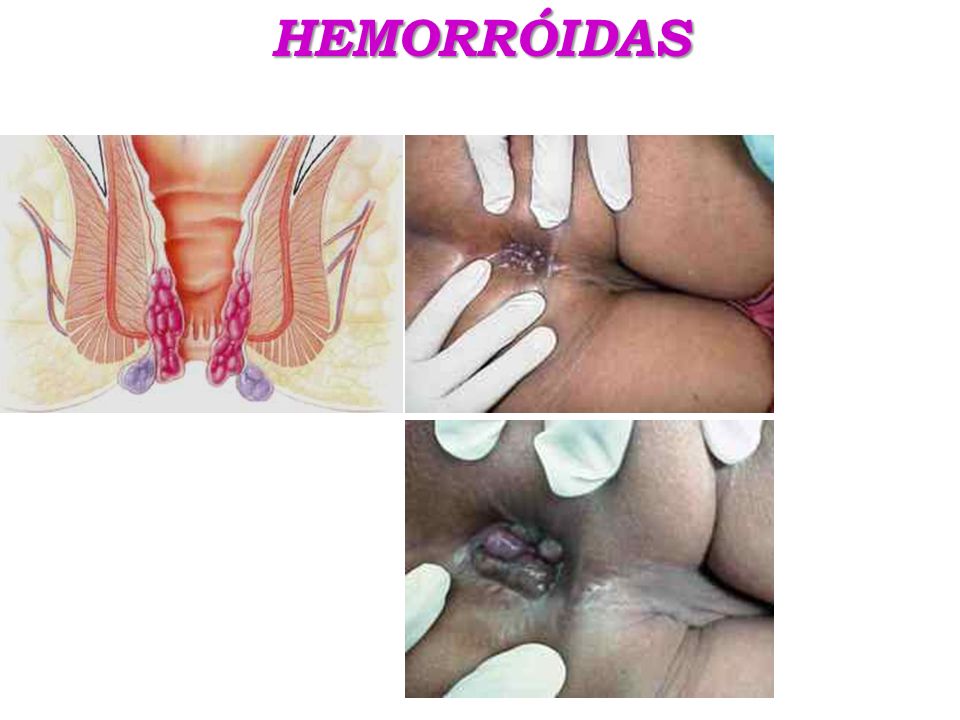 HEMORRÓIDAS