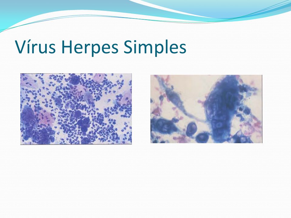 Vírus Herpes Simples