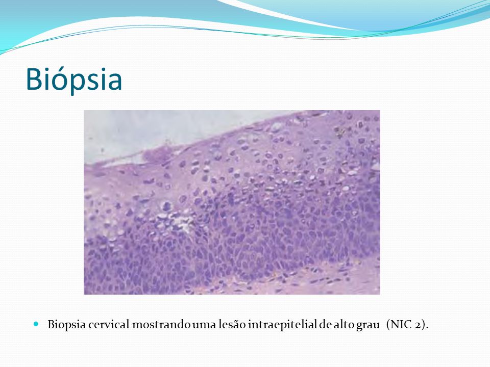 Biópsia Biopsia cervical mostrando uma lesão intraepitelial de alto grau (NIC 2).
