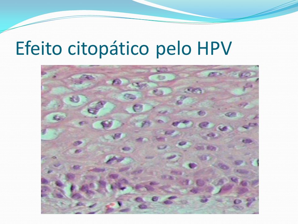 Efeito citopático pelo HPV