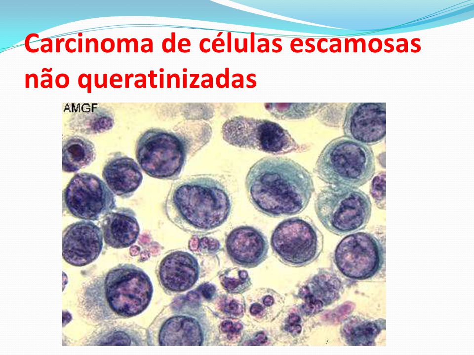Carcinoma de células escamosas não queratinizadas