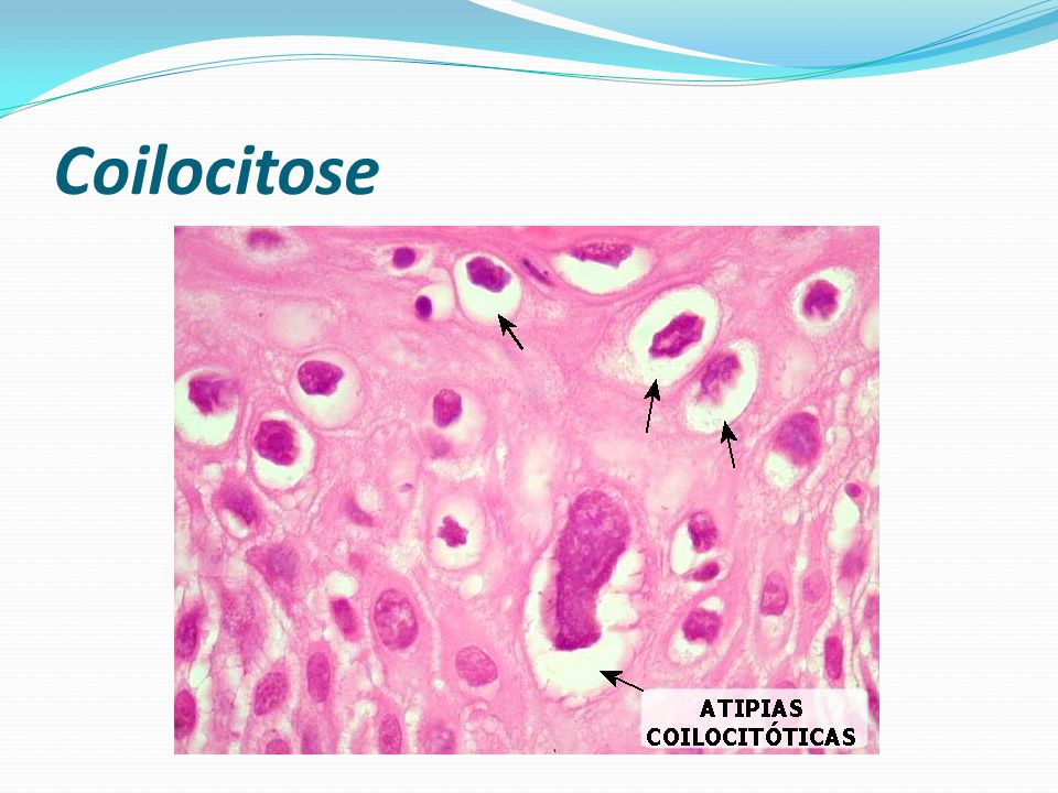 Coilocitose
