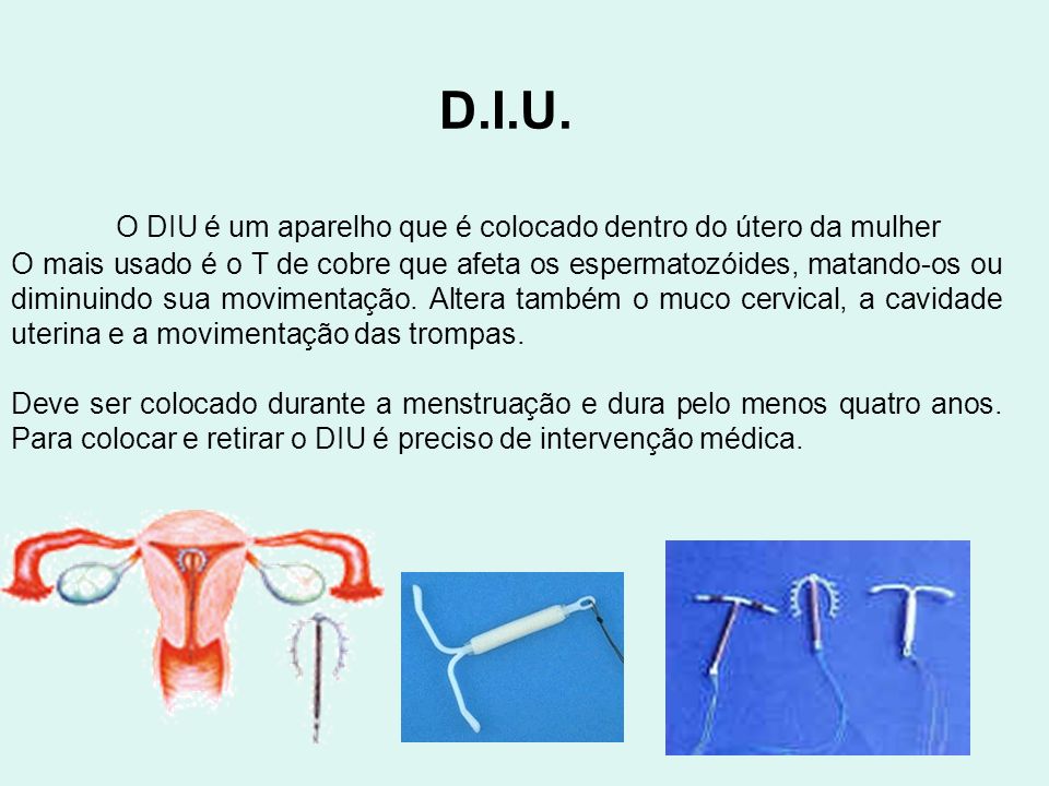 D.I.U. O DIU é um aparelho que é colocado dentro do útero da mulher