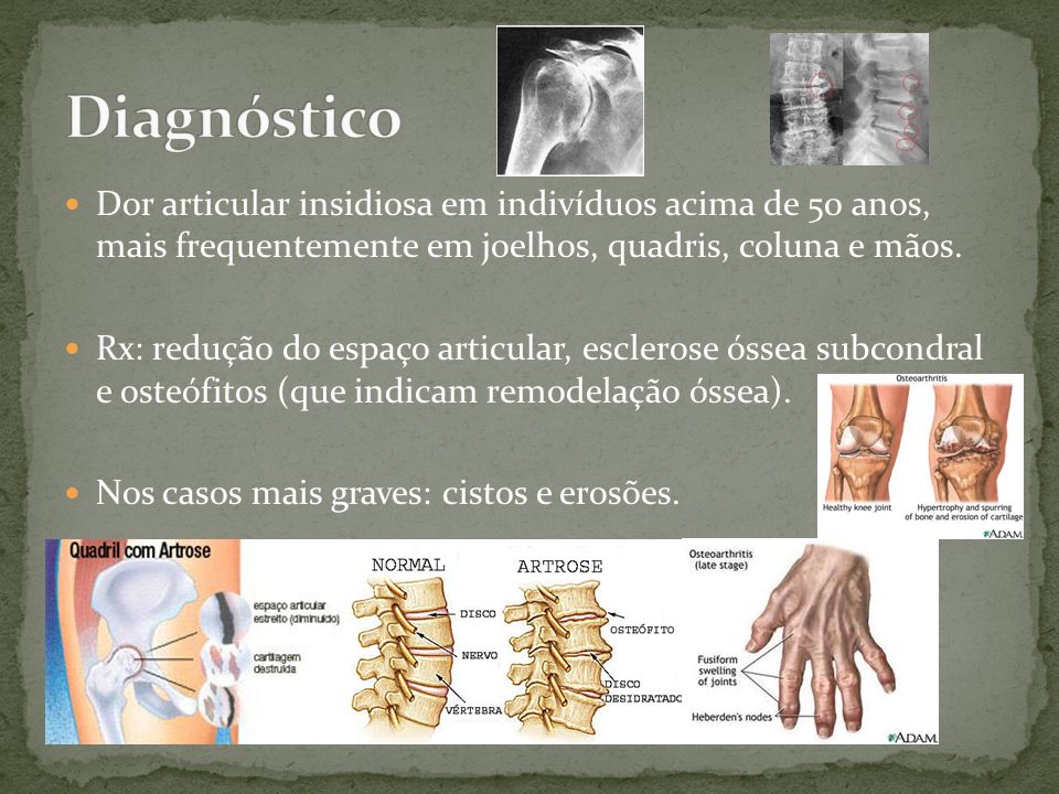 Diagnóstico Dor articular insidiosa em indivíduos acima de 50 anos, mais frequentemente em joelhos, quadris, coluna e mãos.