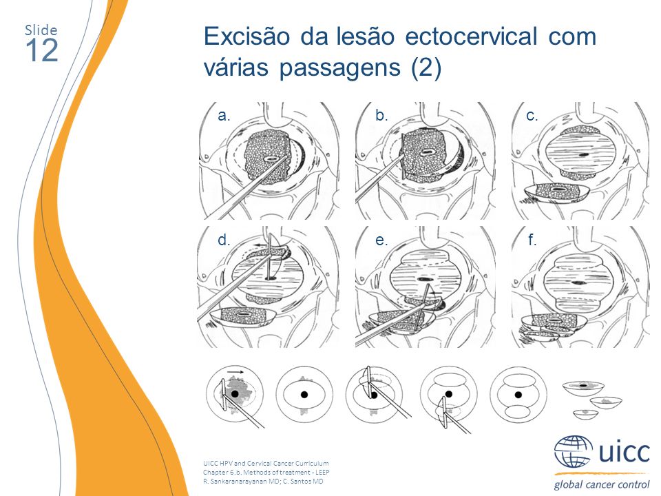 12 Excisão da lesão ectocervical com várias passagens (2) Slide a. b.