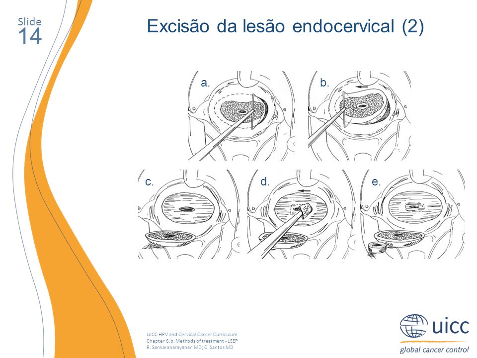14 Excisão da lesão endocervical (2) Slide a. b. c. d. e.