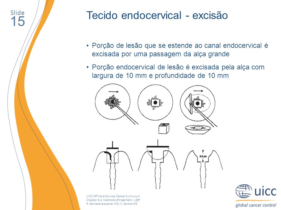 15 Tecido endocervical - excisão Slide