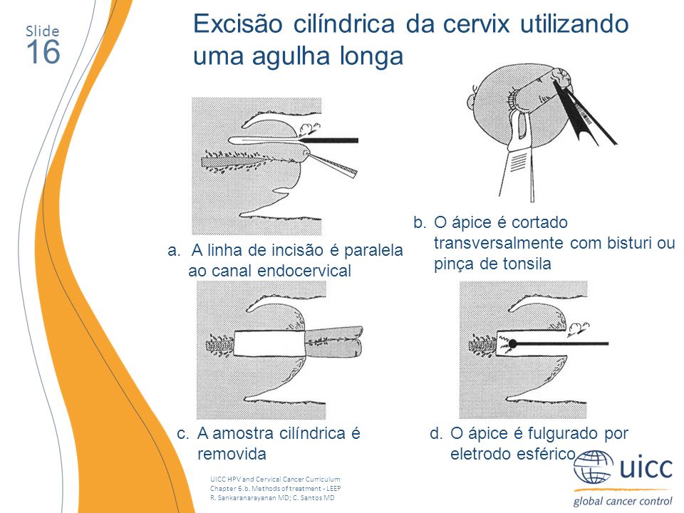 16 Excisão cilíndrica da cervix utilizando uma agulha longa Slide