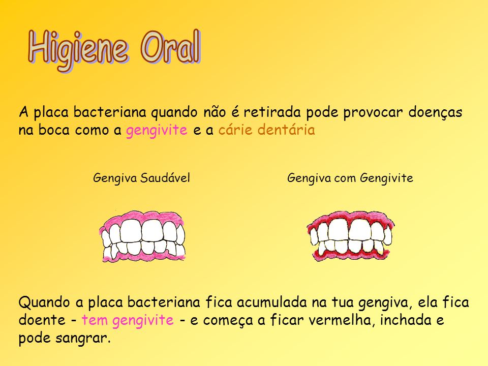Higiene Oral A placa bacteriana quando não é retirada pode provocar doenças na boca como a gengivite e a cárie dentária.