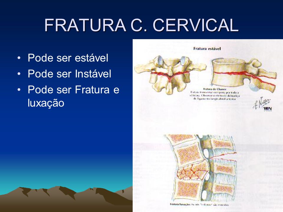 FRATURA C. CERVICAL Pode ser estável Pode ser Instável