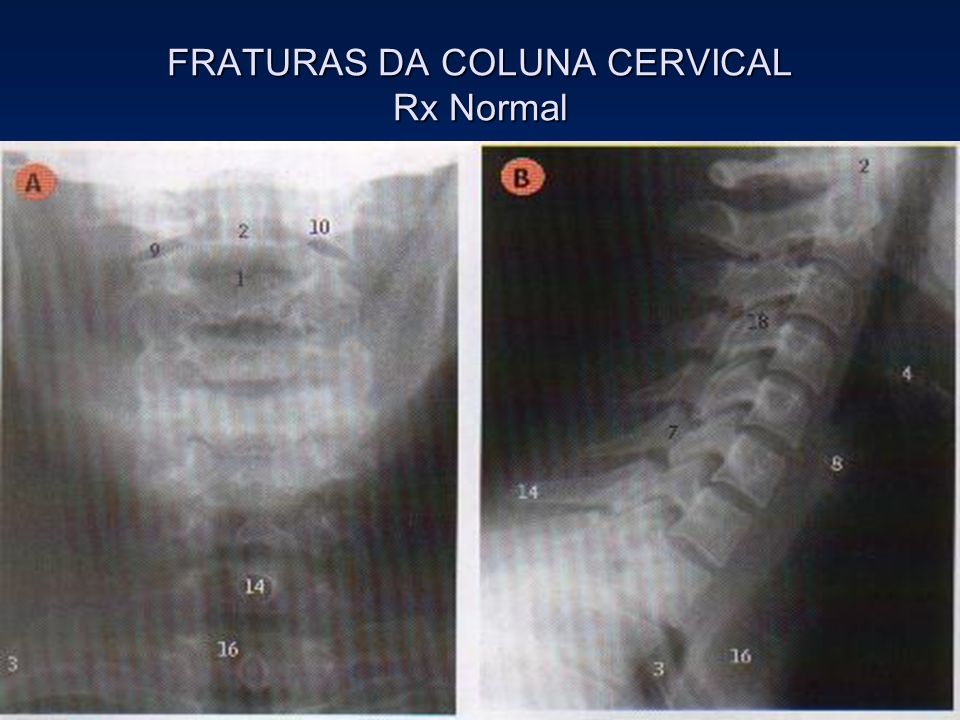 FRATURAS DA COLUNA CERVICAL Rx Normal