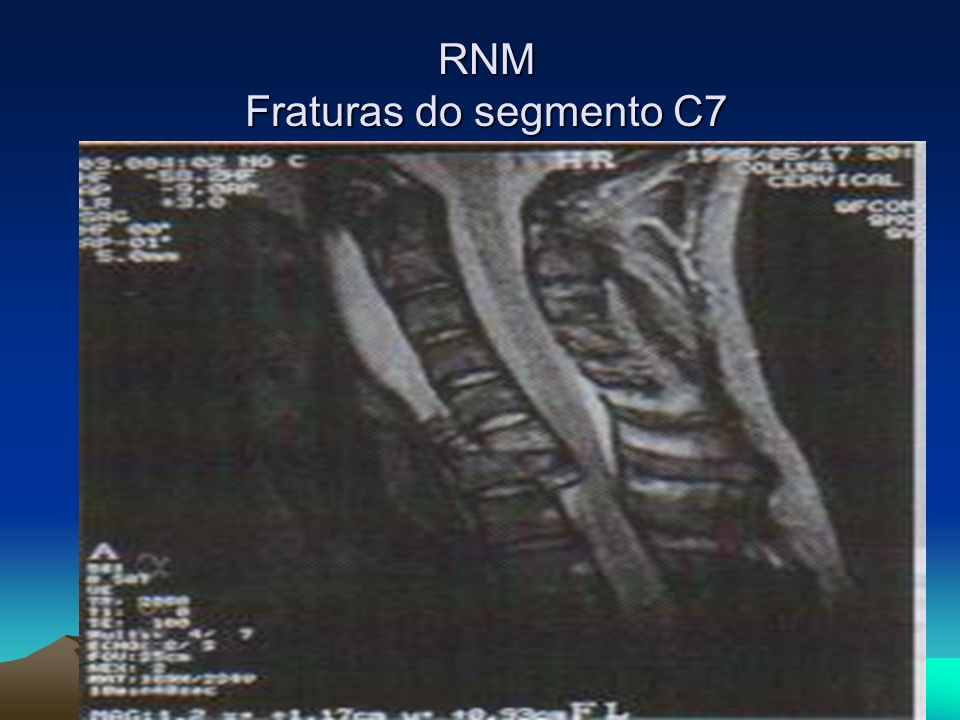 RNM Fraturas do segmento C7