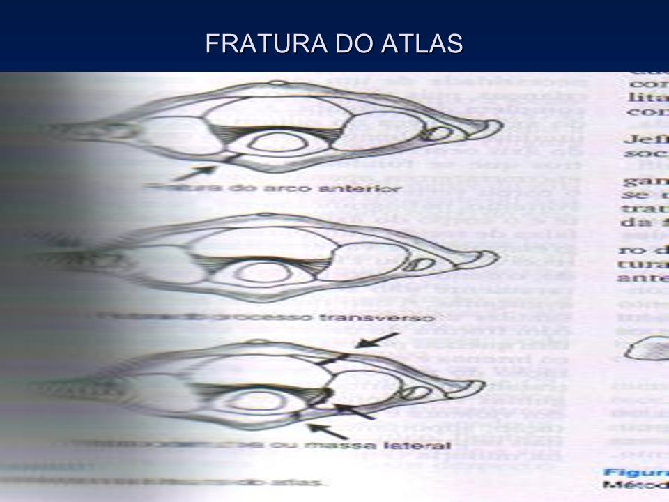 FRATURA DO ATLAS
