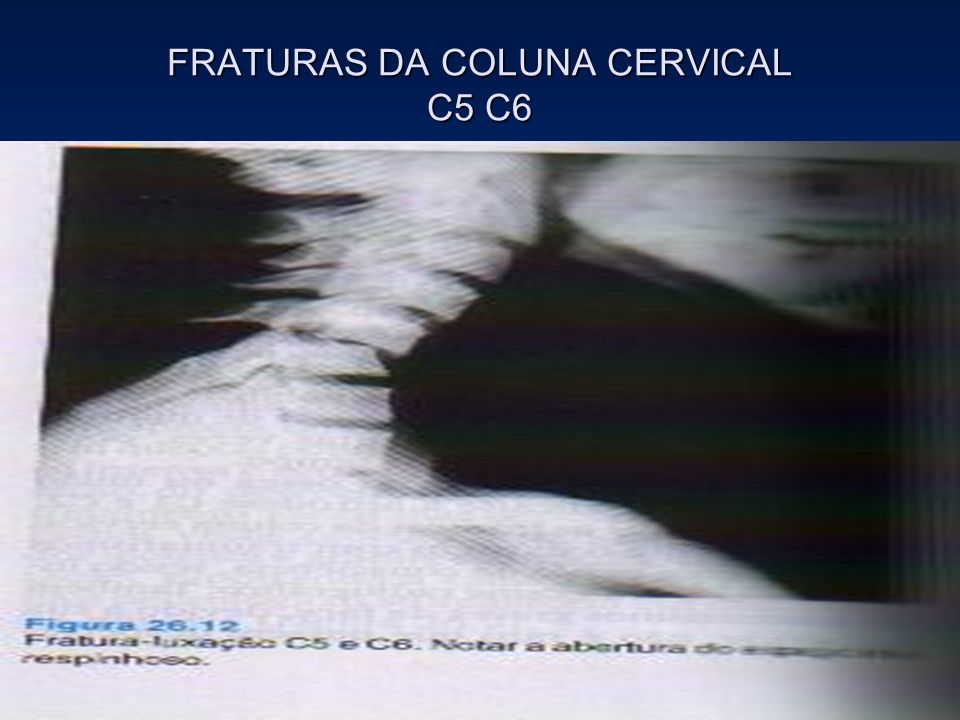 FRATURAS DA COLUNA CERVICAL C5 C6