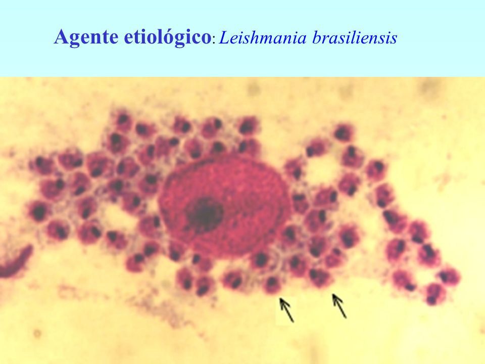 Agente etiológico: Leishmania brasiliensis