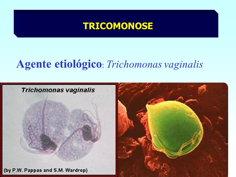 Agente etiológico: Trichomonas vaginalis
