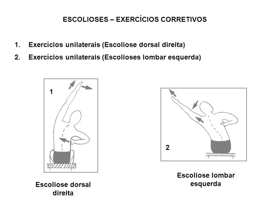 ESCOLIOSES – EXERCÍCIOS CORRETIVOS Escoliose lombar esquerda
