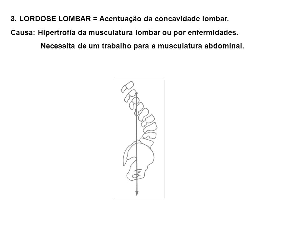 3. LORDOSE LOMBAR = Acentuação da concavidade lombar.