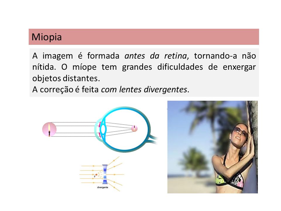 Miopia A imagem é formada antes da retina, tornando-a não nítida. O míope tem grandes dificuldades de enxergar objetos distantes.