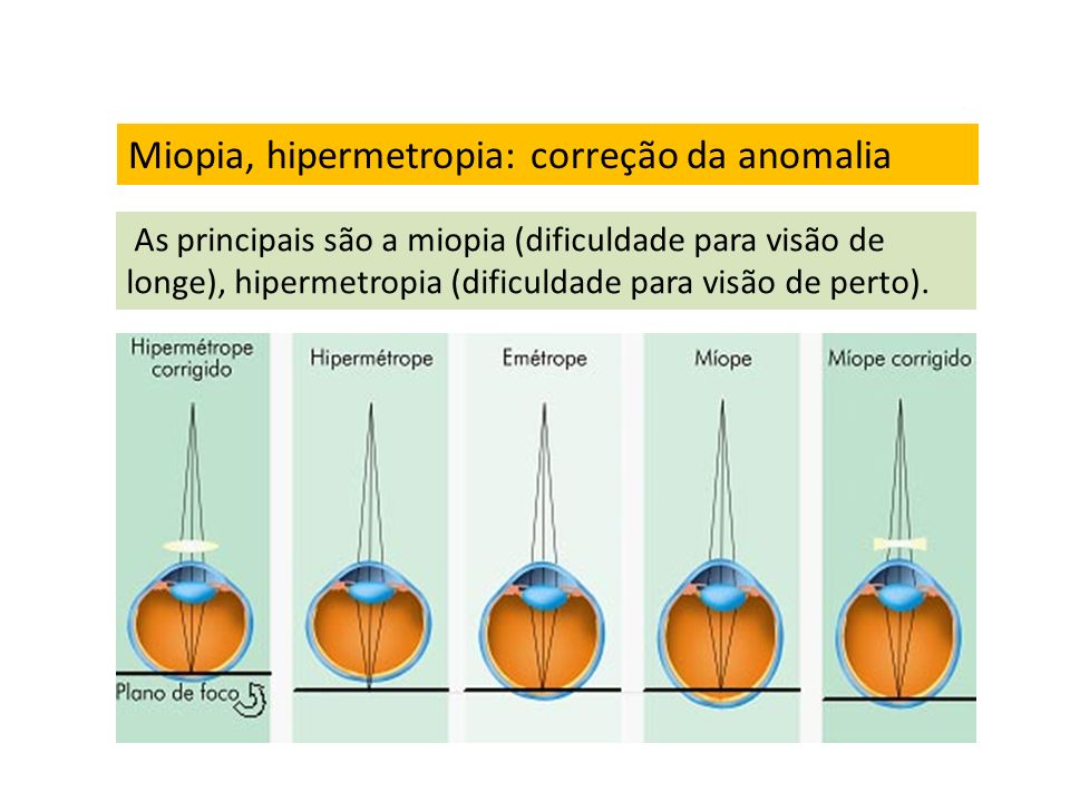 Miopia, hipermetropia: correção da anomalia