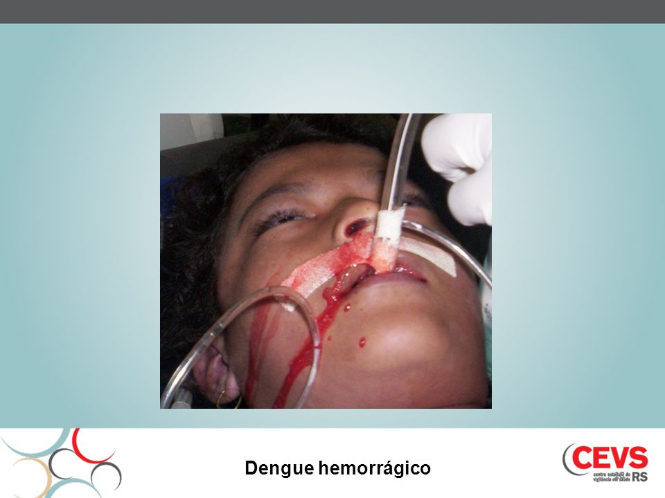 Dengue hemorrágico 18
