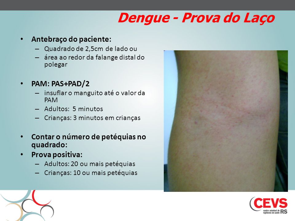 Dengue - Prova do Laço Antebraço do paciente: PAM: PAS+PAD/2