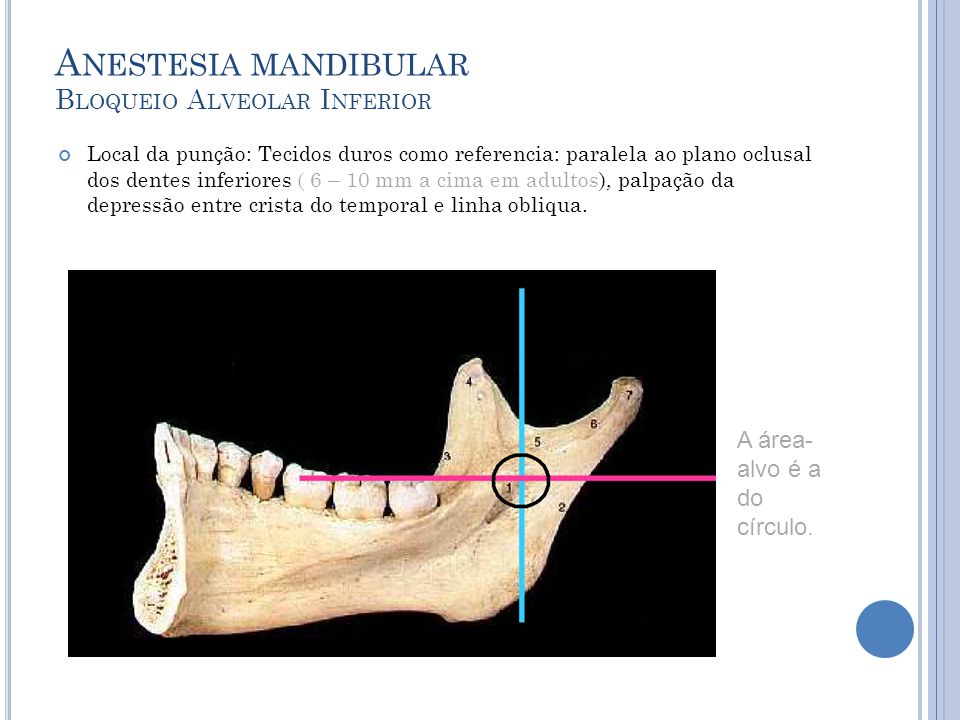Anestesia mandibular Bloqueio Alveolar Inferior
