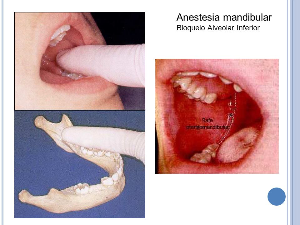 Anestesia mandibular Bloqueio Alveolar Inferior