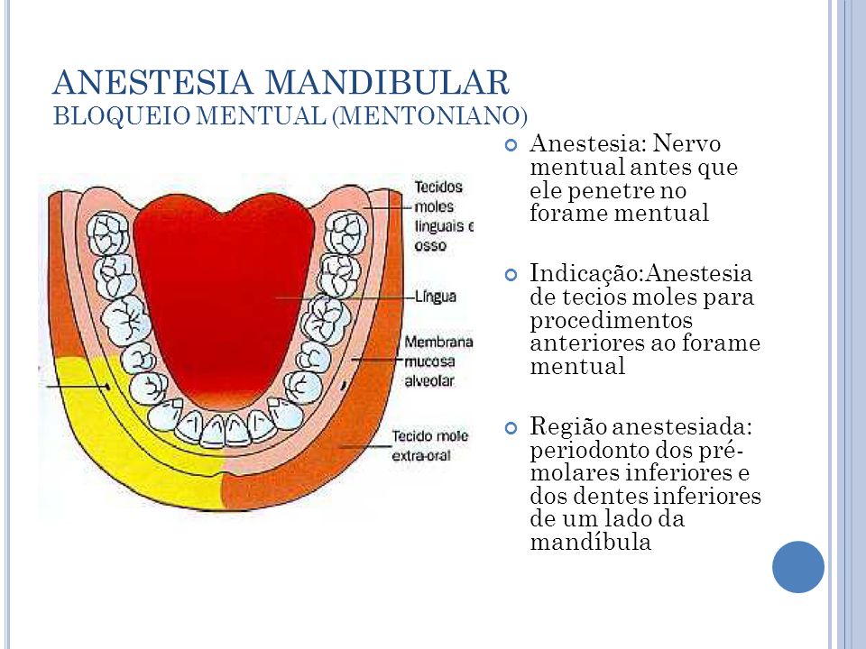 ANESTESIA MANDIBULAR BLOQUEIO MENTUAL (MENTONIANO)