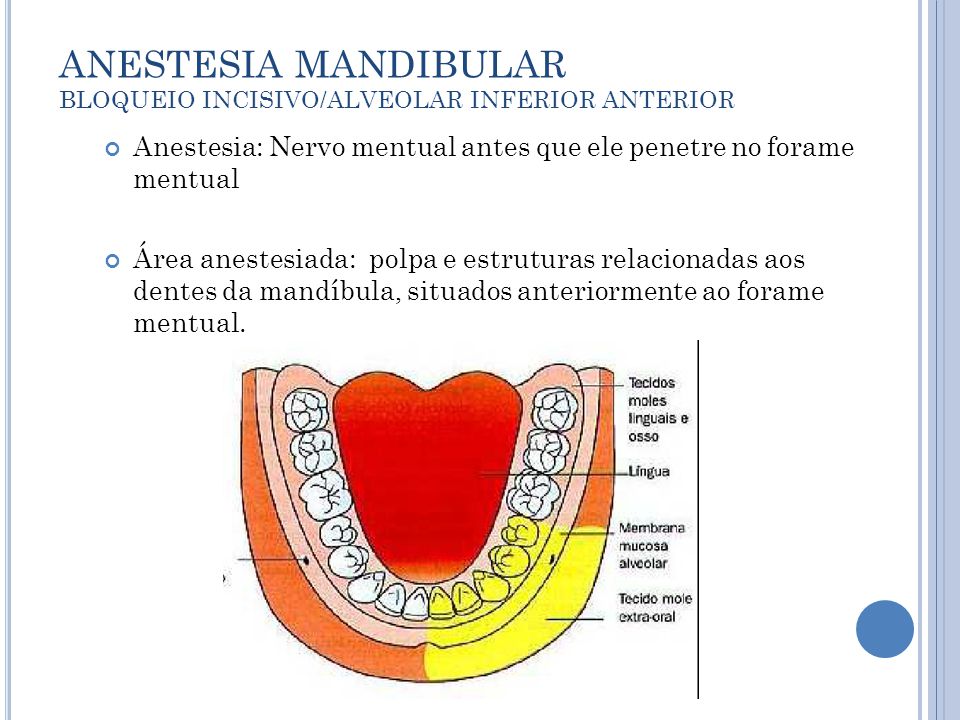 ANESTESIA MANDIBULAR BLOQUEIO INCISIVO/ALVEOLAR INFERIOR ANTERIOR